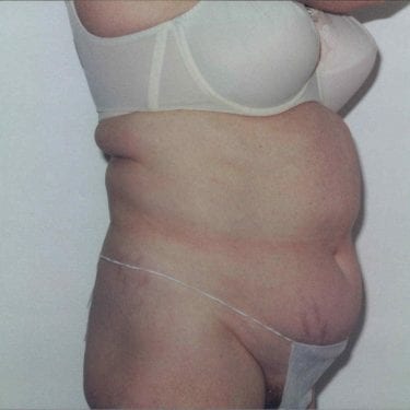 Tummy Tuck Patient 11 - Before - 1