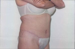 Tummy Tuck Patient 11 - After - 1 Thumbnail