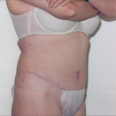 Tummy Tuck Patient 11 - After - 1