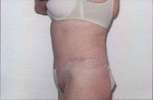 Tummy Tuck Patient 11 - After - 2 Thumbnail