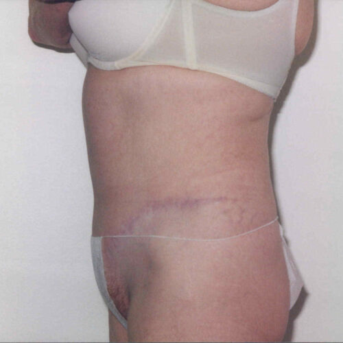 Tummy Tuck Patient 11 - After - 2