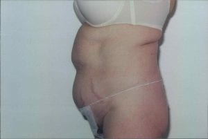 Tummy Tuck Patient 11 - Before - 2 Thumbnail