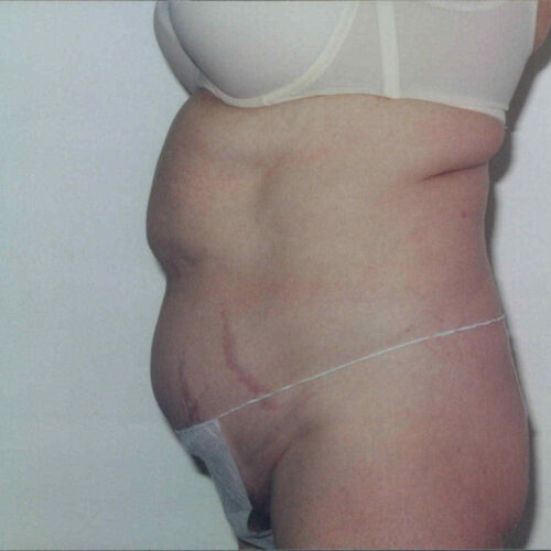 Tummy Tuck Patient 11 - Before - 2