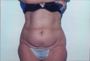 Tummy Tuck Patient 12 - Before - 1 Thumbnail