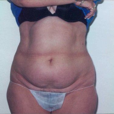 Tummy Tuck Patient 12 - Before - 1