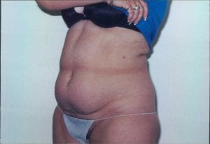 Tummy Tuck Patient 12 - Before - 2 Thumbnail