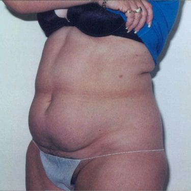Tummy Tuck Patient 12 - Before - 2