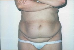 Tummy Tuck Patient 13 - Before - 1 Thumbnail