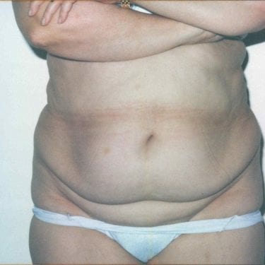 Tummy Tuck Patient 13 - Before - 1