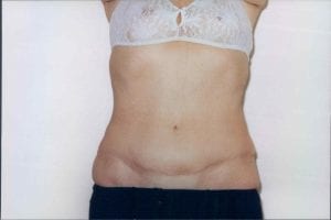Tummy Tuck Patient 13 - After - 1 Thumbnail