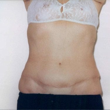 Tummy Tuck Patient 13 - After - 1