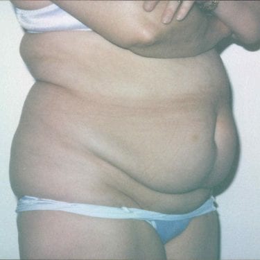 Tummy Tuck Patient 13 - Before - 2