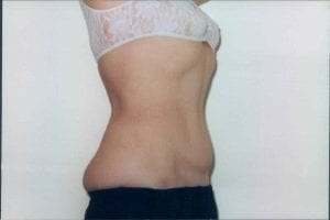 Tummy Tuck Patient 13 - After - 2 Thumbnail