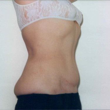 Tummy Tuck Patient 13 - After - 2