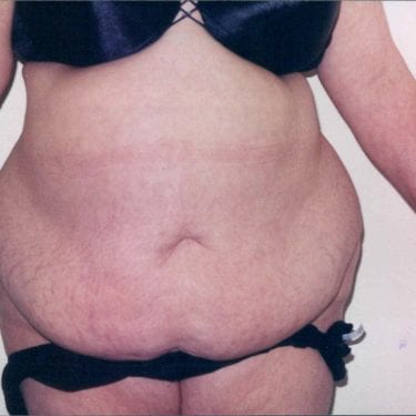 Tummy Tuck Patient 14 - Before - 1