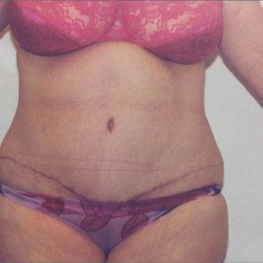 Tummy Tuck Patient 14 - After - 1