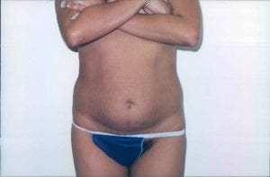 Tummy Tuck Patient 15 - Before - 1 Thumbnail