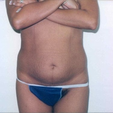 Tummy Tuck Patient 15 - Before - 1