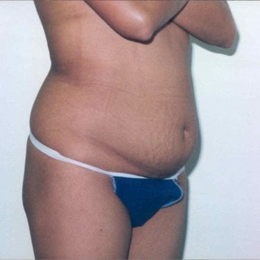 Tummy Tuck Patient 15 - Before - 2