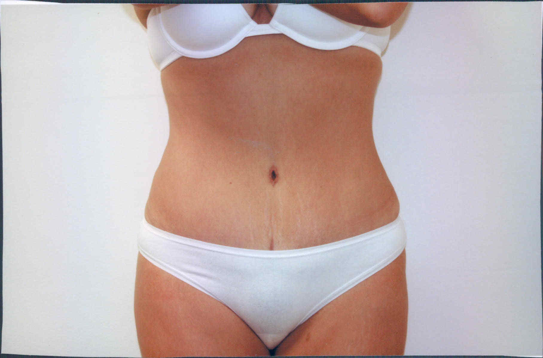 tummy tuck after 1a