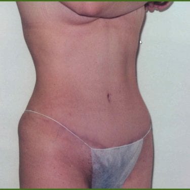 Tummy Tuck Patient 18 - After - 1