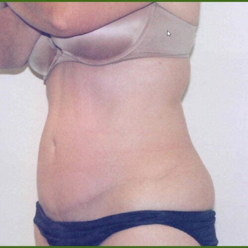 Tummy Tuck Patient 04 - After - 1