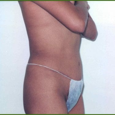 Tummy Tuck Patient 17 - After - 1