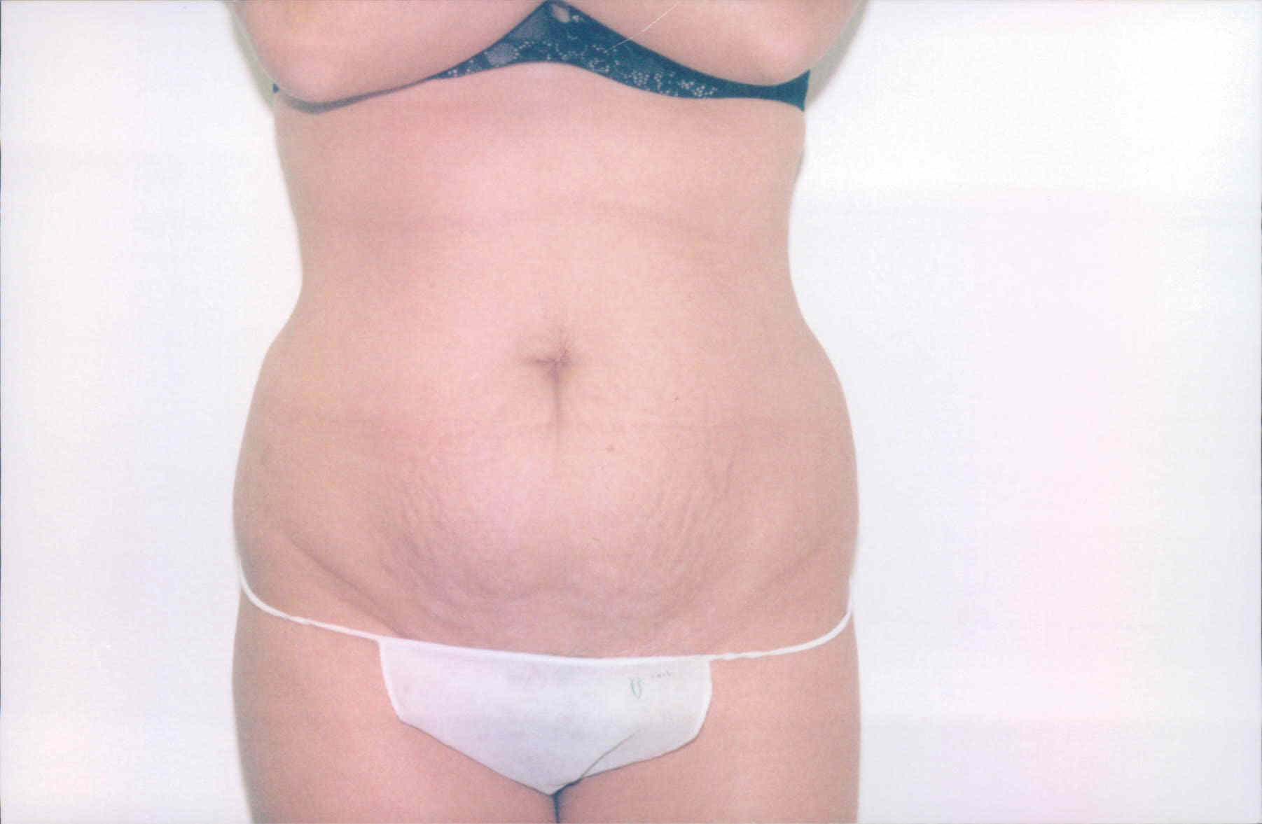 tummy tuck before 1a