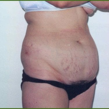 Tummy Tuck Patient 18 - Before - 1