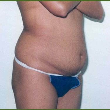 Tummy Tuck Patient 17 - Before - 1