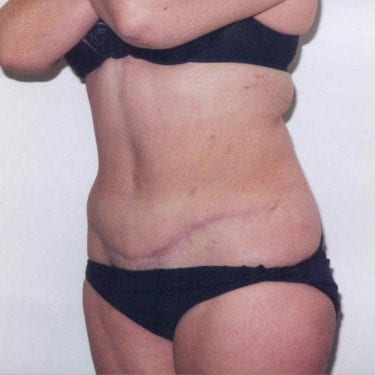 Tummy Tuck Patient 12 - After - 2