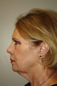 Female Facelift Patient 45 - Before - 3 Thumbnail