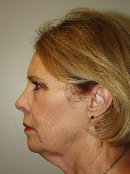 Female Facelift Patient 45 - Before - 3