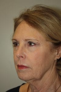 Female Facelift Patient 45 - Before - 2 Thumbnail