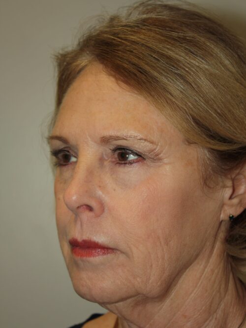 Female Facelift Patient 45 - Before - 2