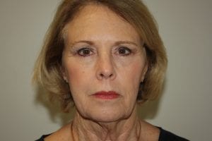 Female Facelift Patient 45 - Before - 1 Thumbnail