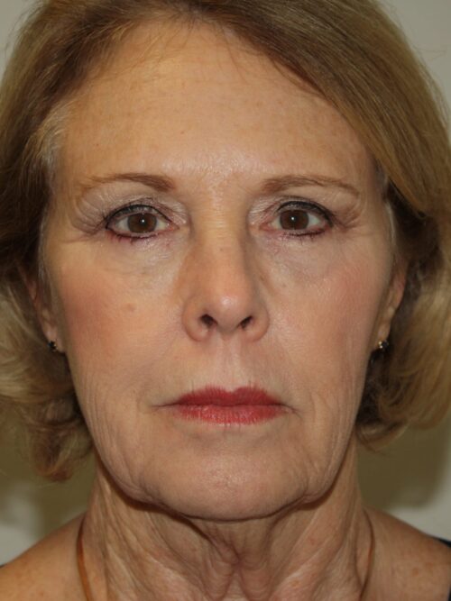 Female Facelift Patient 45 - Before - 1