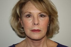 Female Facelift Patient 45 - After - 1 Thumbnail