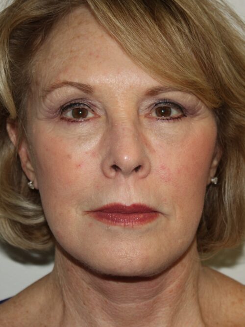 Female Facelift Patient 45 - After - 1