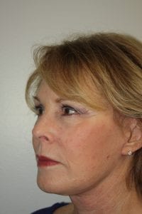 Female Facelift Patient 45 - After - 2 Thumbnail