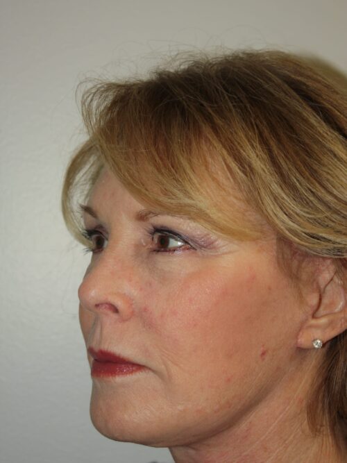 Female Facelift Patient 45 - After - 2