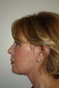 Female Facelift Patient 45 - After - 3 Thumbnail