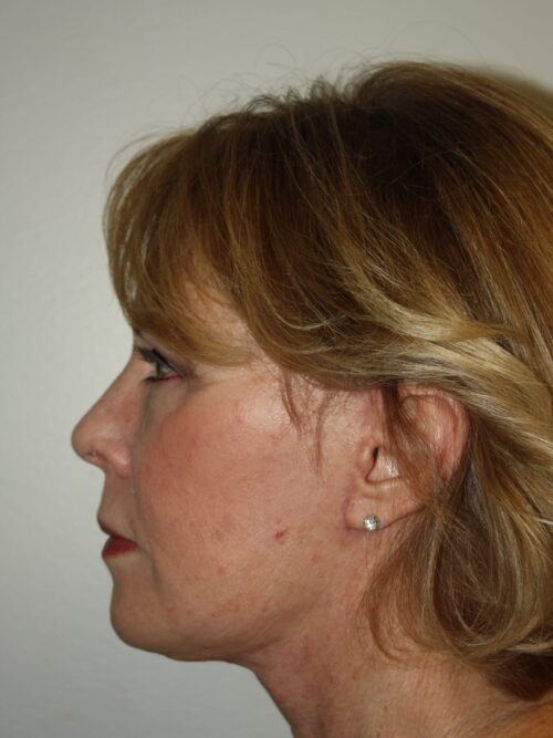 Female Facelift Patient 45 - After - 3