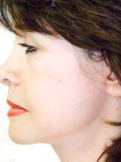 Female Facelift Patient 29 - After - 1