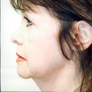 Female Facelift Patient 29 - Before - 1 Thumbnail