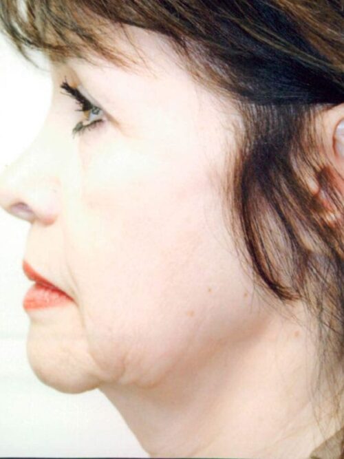 Female Facelift Patient 29 - Before - 1