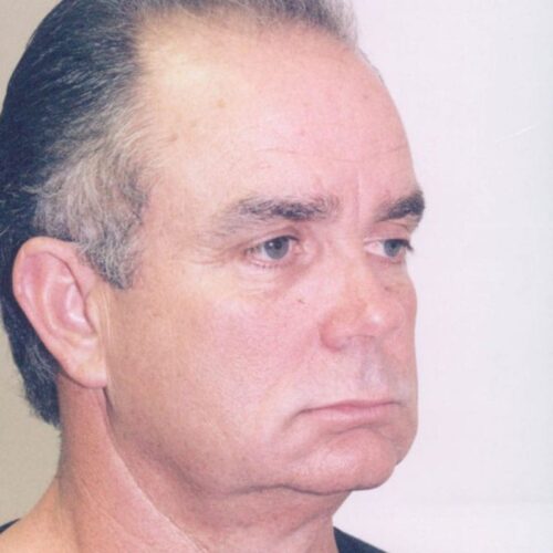 Male Facelift Patient 08 - Before - 2