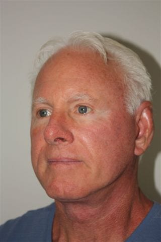 Male Facelift Patient 29 - After - 3