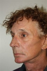 Male Facelift Patient 28 - After - 2 Thumbnail