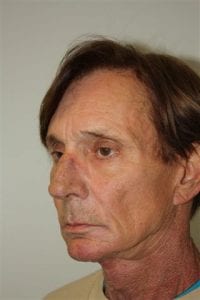 Male Facelift Patient 28 - Before - 2 Thumbnail